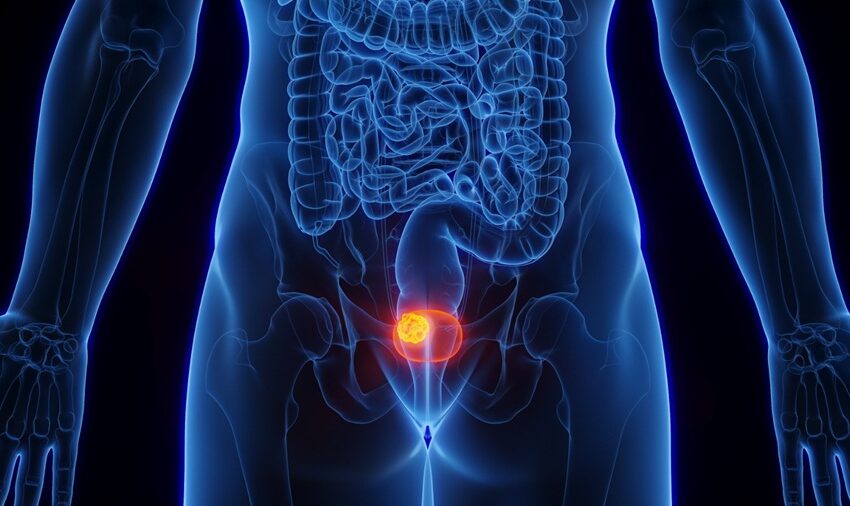  Nueva alternativa de inmunoterapia amplía opciones de tratamiento contra el cáncer de vejiga en Costa Rica