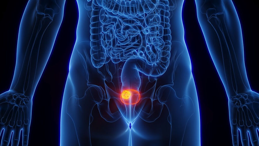 Nueva alternativa de inmunoterapia amplía opciones de tratamiento contra el cáncer de vejiga en Costa Rica