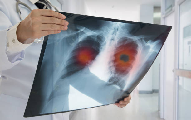 Cáncer de pulmón: estas son las señales de alerta que no debería ignorar